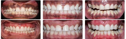 درمان سیاه شدن لثه