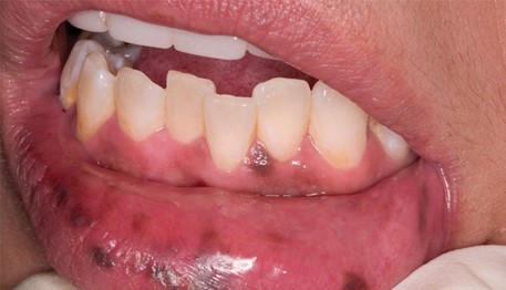 7.سندرم پوتز-جگرز