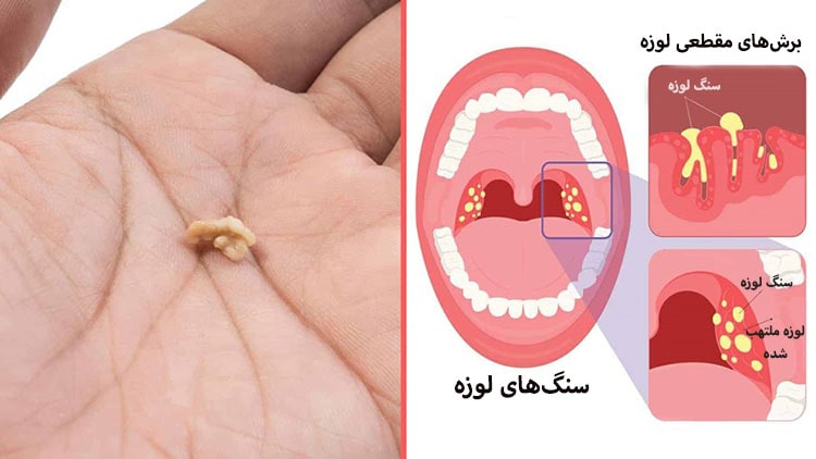 علائم سنگ لوزه، خطرات و راههای درمان آن 2 علت تشکیل سنگ لوزه