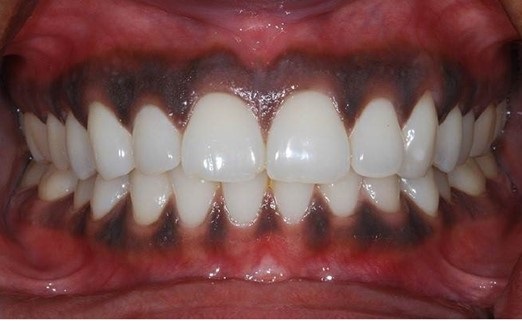 5.ژنژیویت اولسراتیو نکروزان حاد