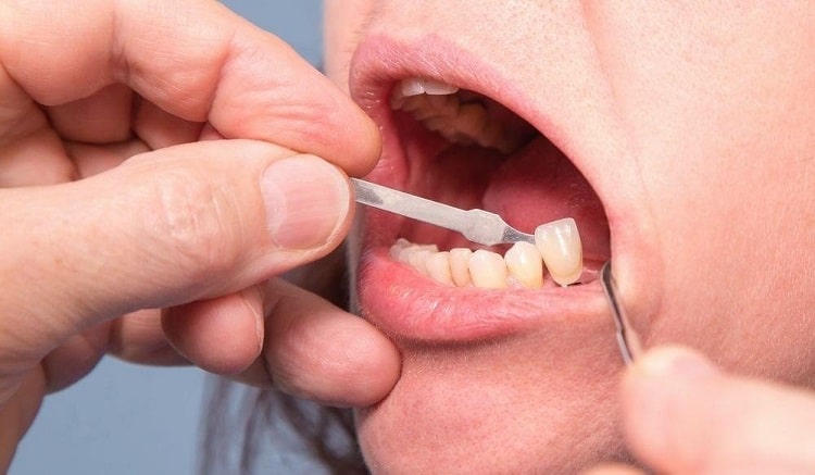 تعویض روکش دندان