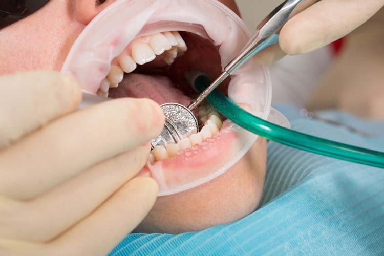 چگونگی تعویض روکش دندان