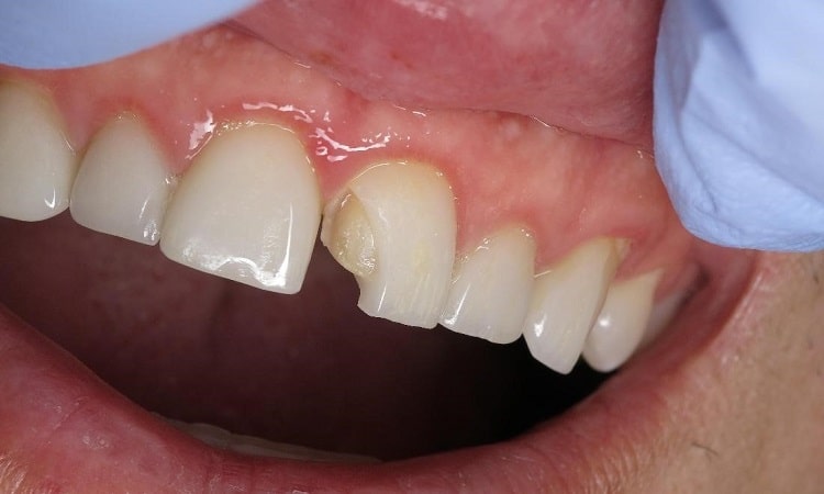 علائم پایان طول عمر لمینت دندان
