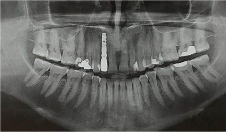  تشخیص عفونت ایمپلنت دندان