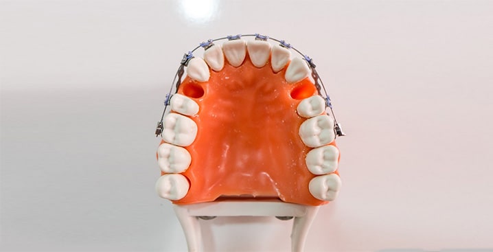 کشیدن دندان 4 در ارتودنسی