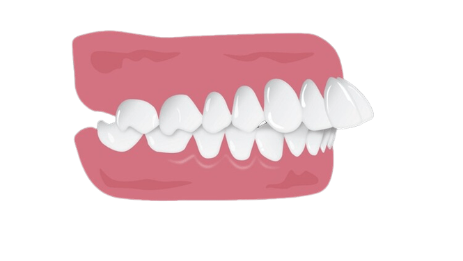 اورجت یا جلوزدگی دندان‌های فک بالایی چیست؟